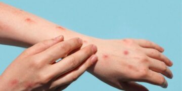 Especial atención en la Universidad del Quindío por brote de varicela