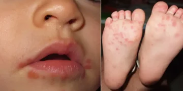 ¡Precaución! Brote de “boca, manos y pies” en Armenia deja 111 casos