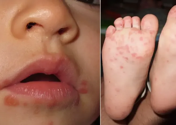 ¡Precaución! Brote de “boca, manos y pies” en Armenia deja 111 casos